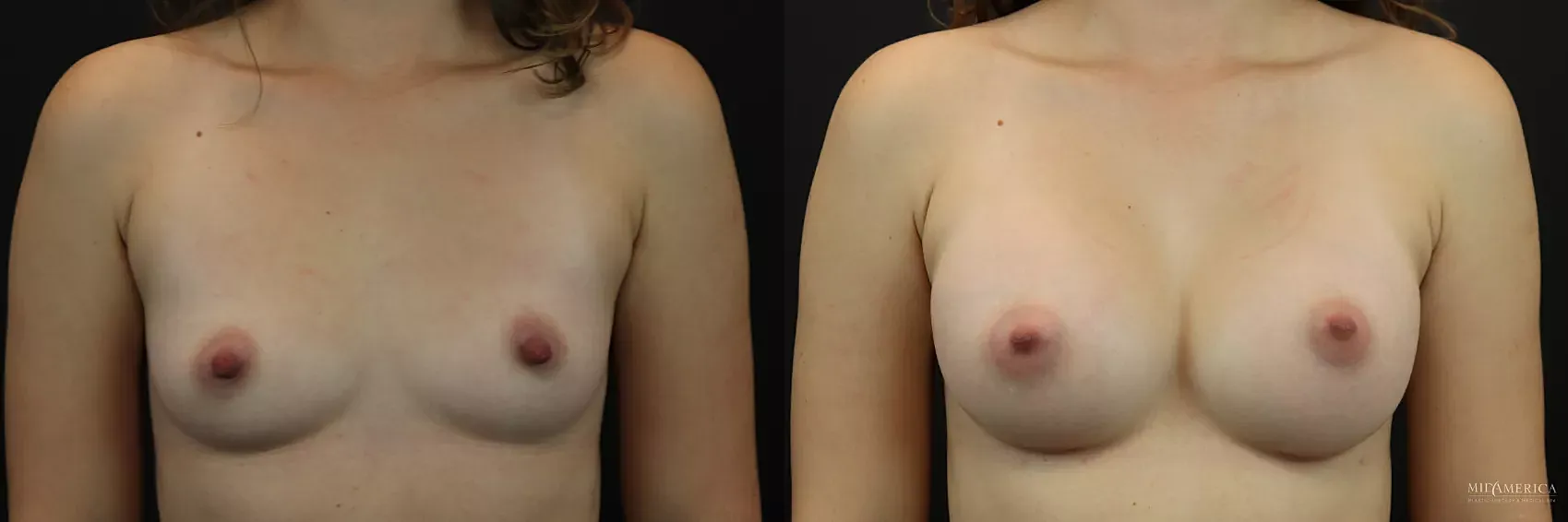Before & After Breast Augmentation Case 247 Front View in St. Louis, MO
