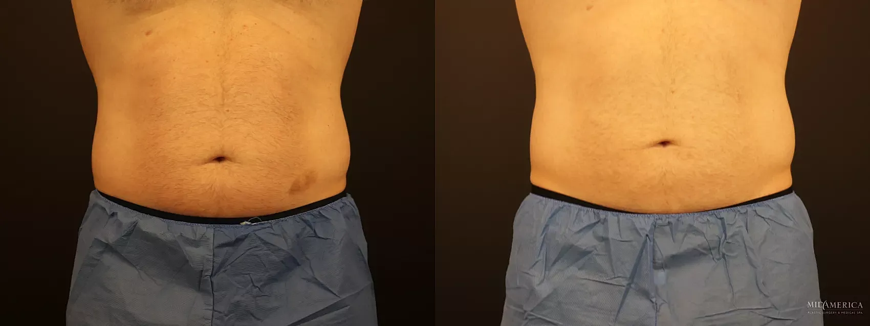 Before & After CoolSculpting Case 274 Front View in St. Louis, MO