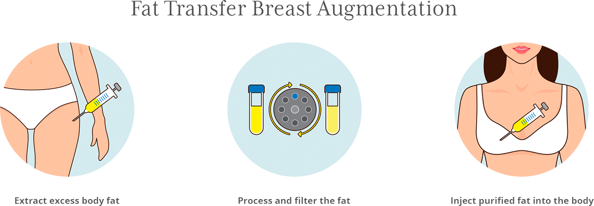 Fat Transfer Breast Augmentation