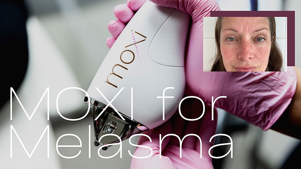 MOXI for Melasma poster