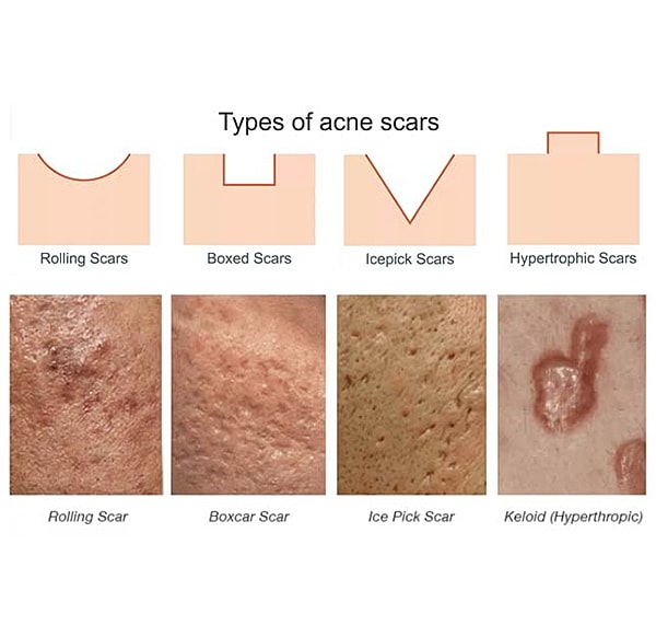 TCA Cross Acne Scar Treatment