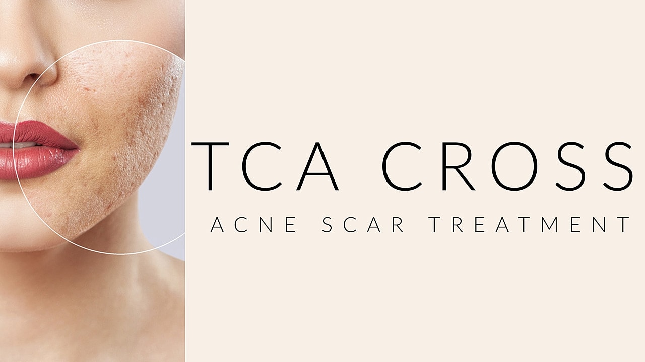 TCA Cross Acne Scar Treatment poster