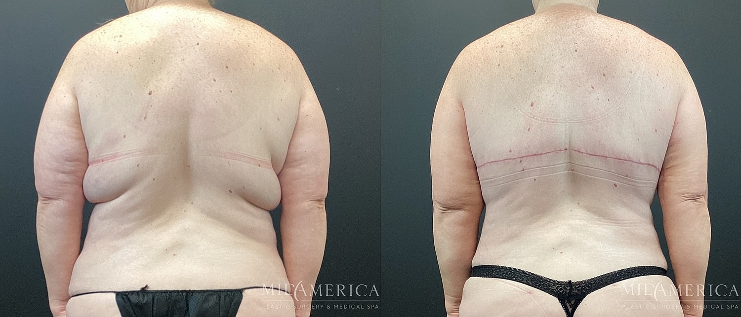 Before and after body contouring treatment comparison.