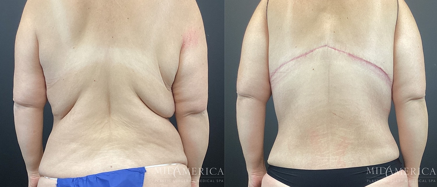 Before and after body contouring treatment comparison.