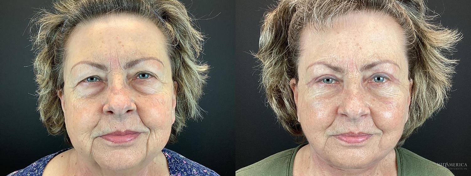 Before and after facial transformation comparison.