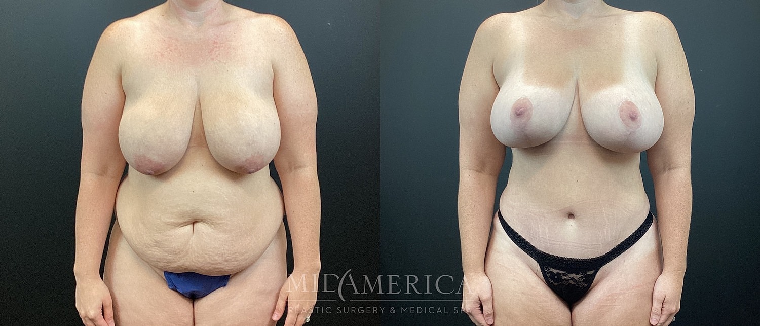 Before and after body transformation image.