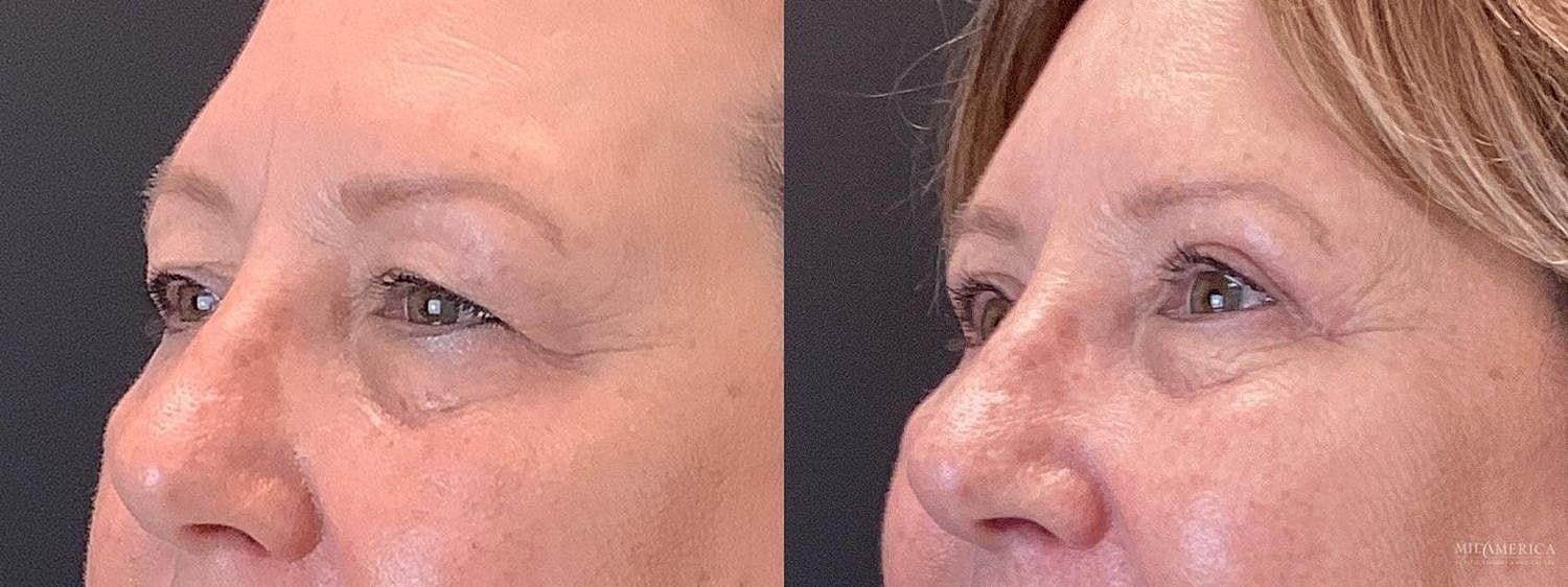 Before and after facial rejuvenation comparison.