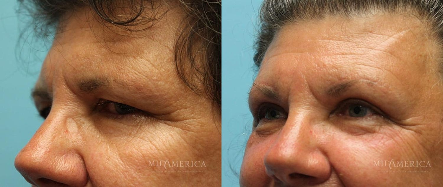 Before and after facial treatment comparison.