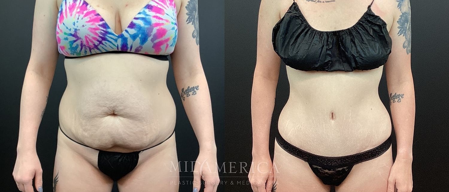 Before and after body image transformation photo.