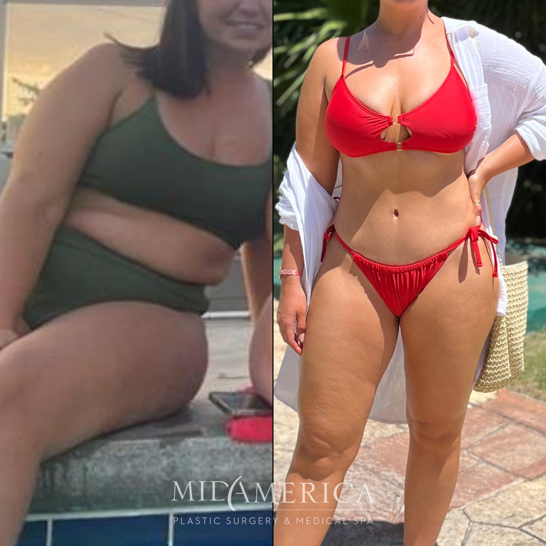 Before and after body transformation photos in swimwear.