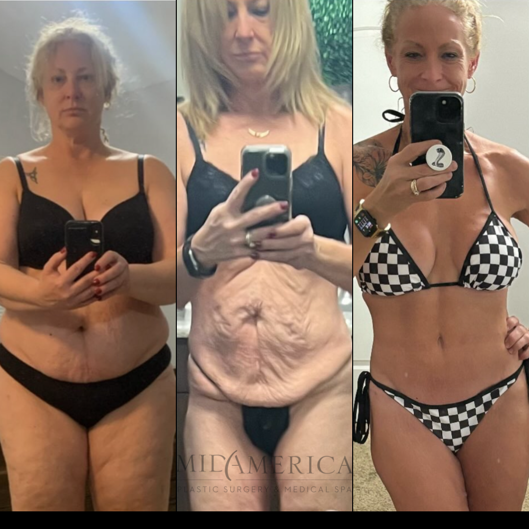 Transformation journey showcasing body changes over time.