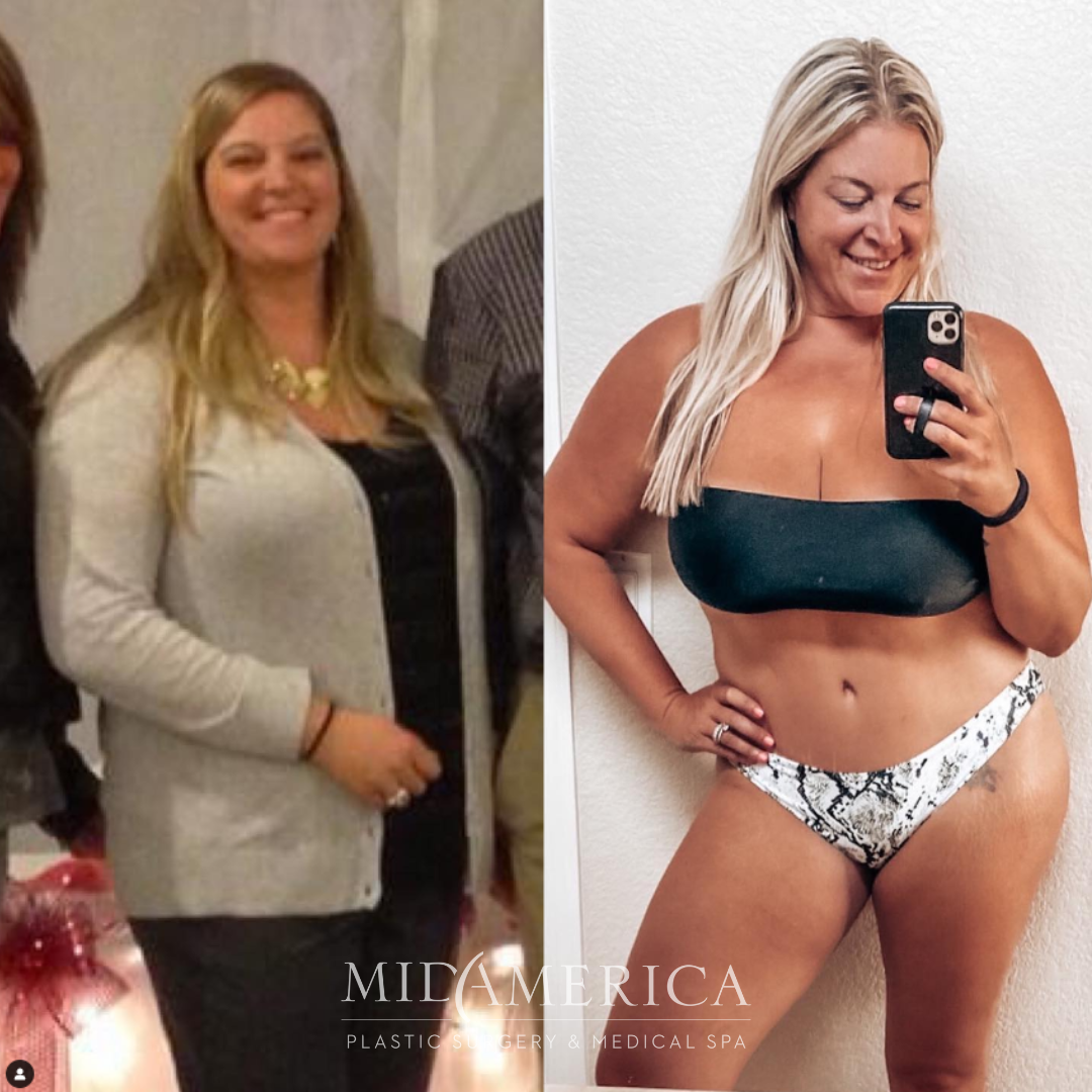 Before and after weight loss transformation image.