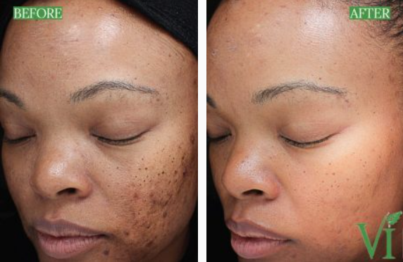 Skin treatment results: before and after photos.