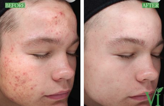 Before and after acne treatment results.