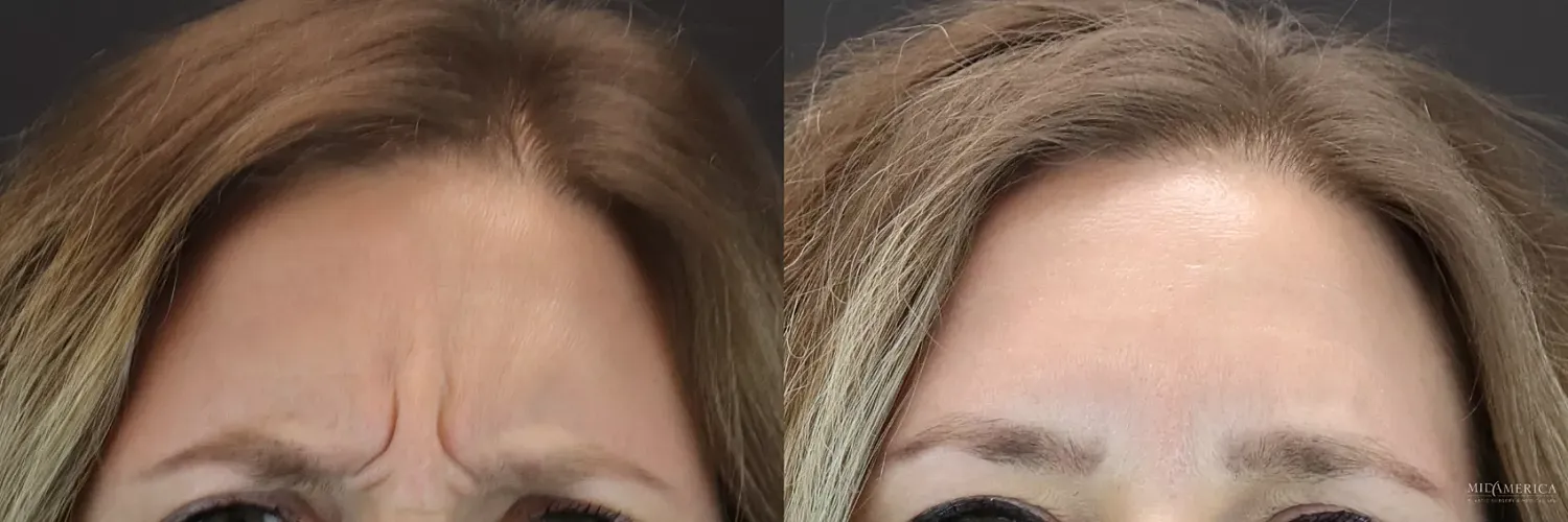 Before & After Botox/Dysport Case 195 Front View in St. Louis, MO