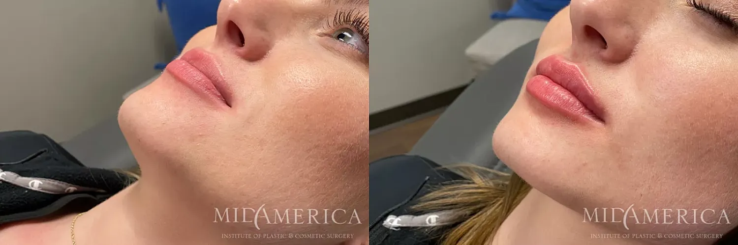 Before & After Dermal Fillers Case 166 View #1 View in St. Louis, MO