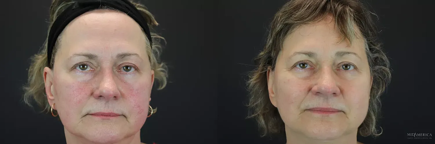 Before & After Laser Services  Case 185 Front View in St. Louis, MO