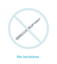 no incisions