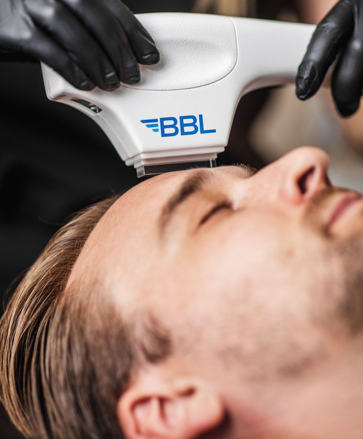 BBL skin treatment on a man's forehead.