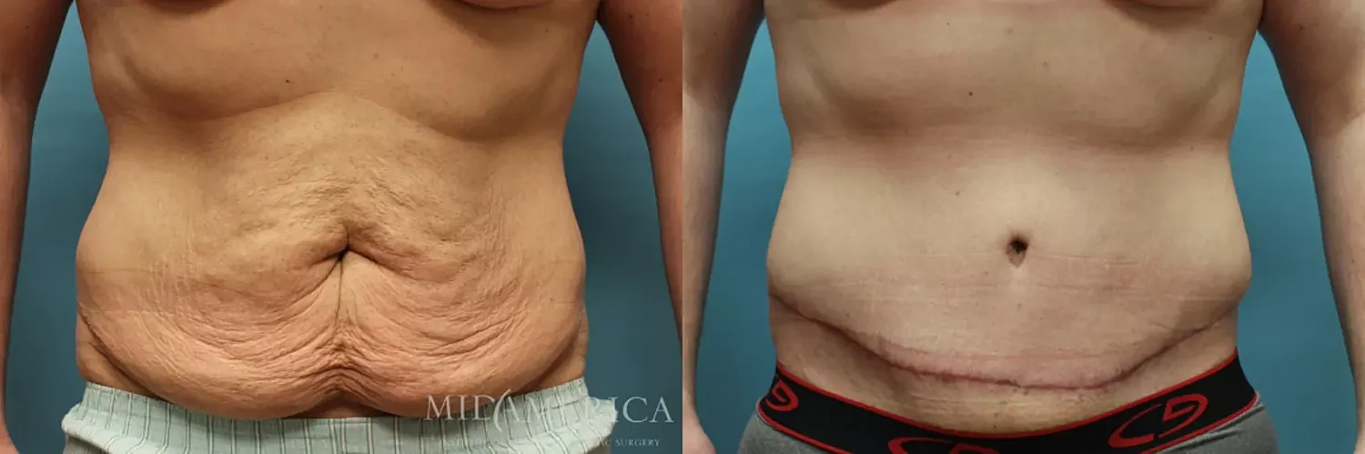 Before & After Tummy Tuck Case 72 View #1 View in St. Louis, MO