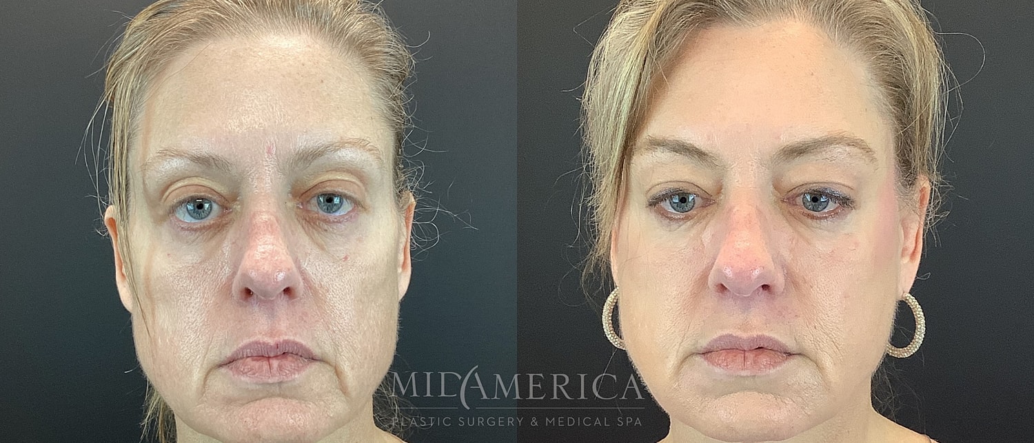 Sculptra Patient 11 before & afters | MidAmerica