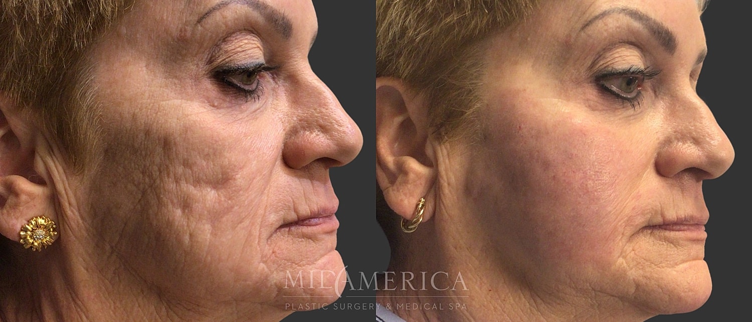 Sculptra Before & After