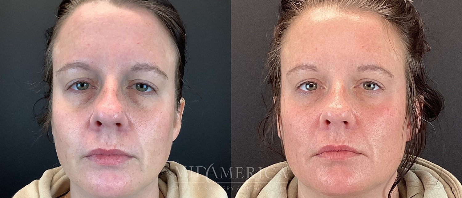 Sculptra Before & After