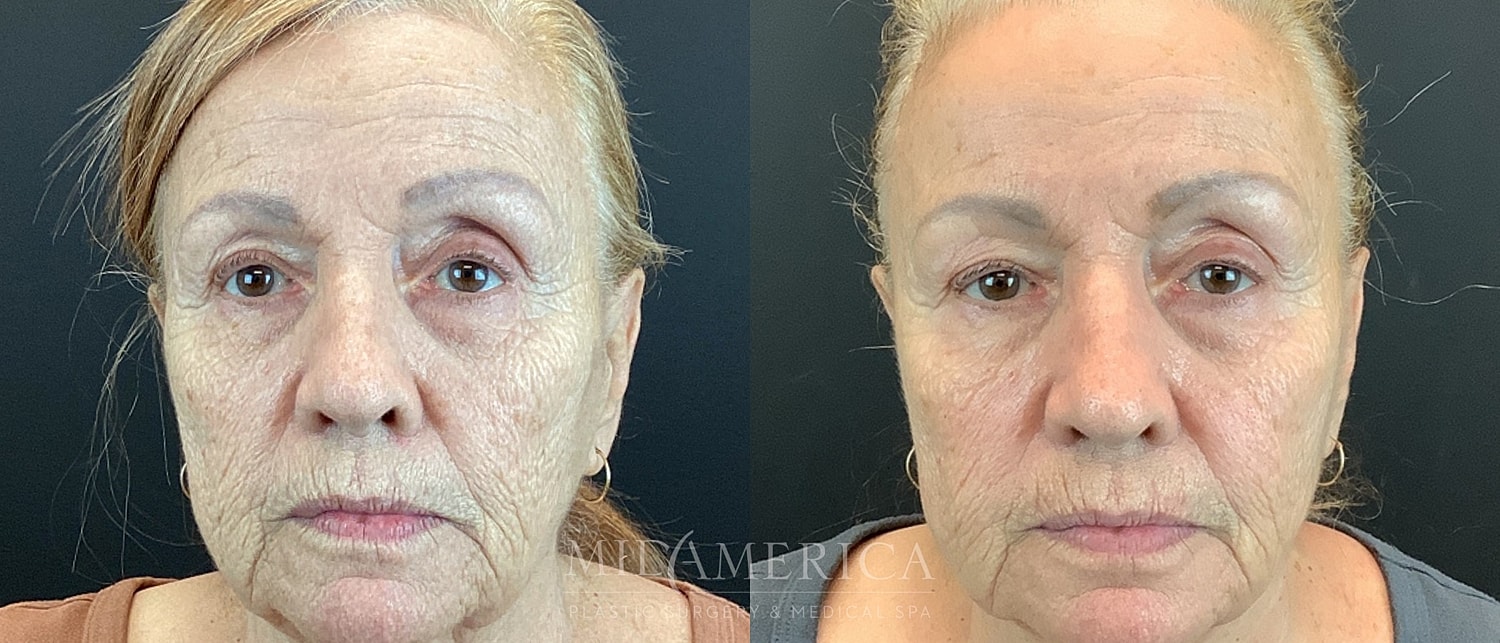 Before and after facial treatment comparison.