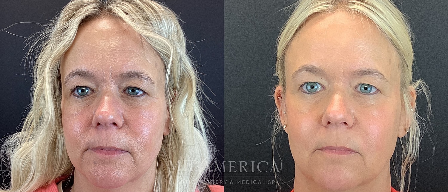 Before and after facial treatment comparison image.