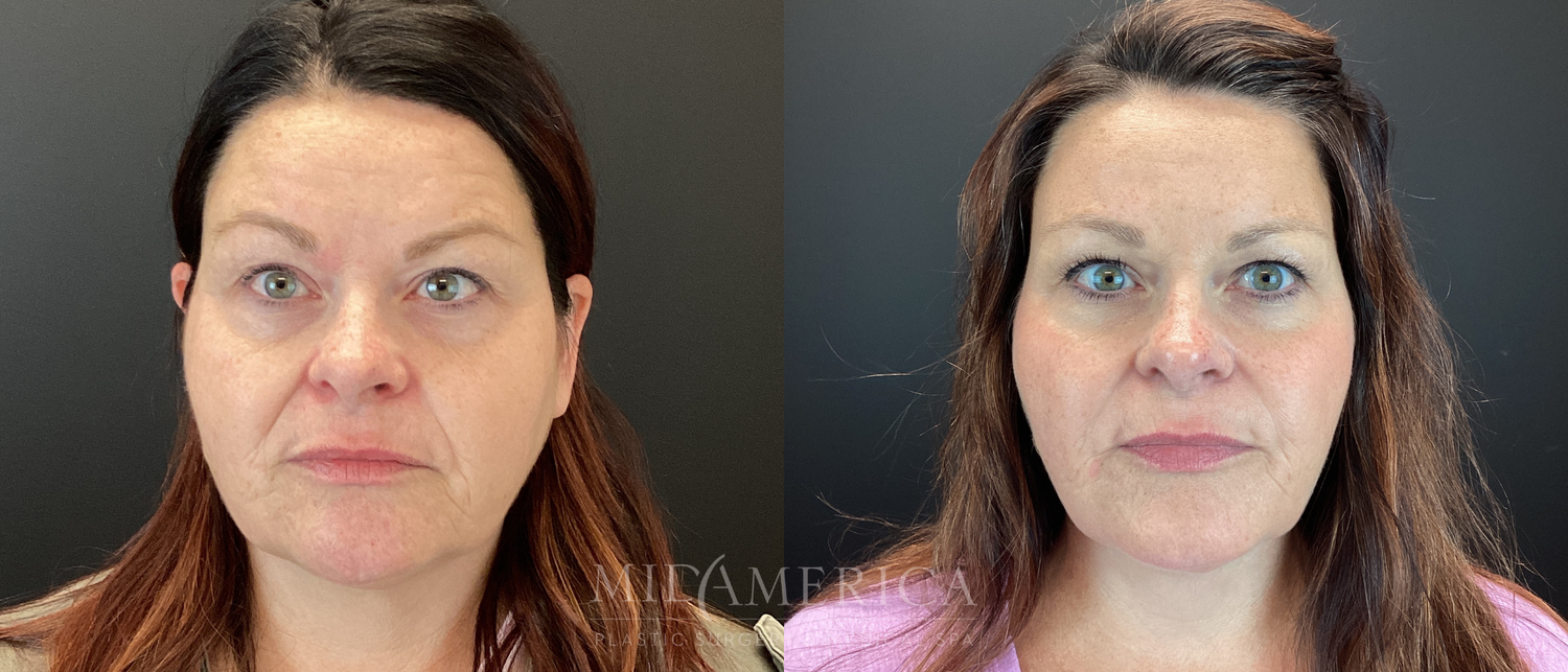 Sculptra Before & After