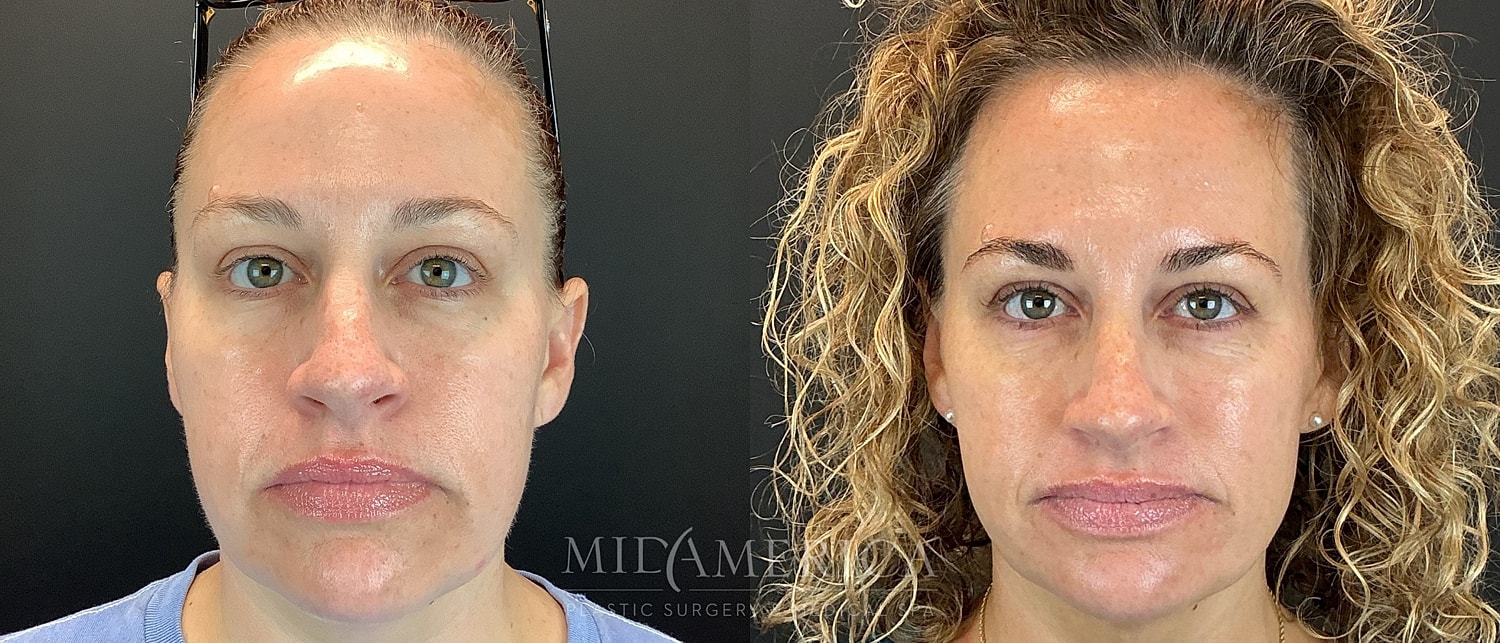 Sculptra Before & After