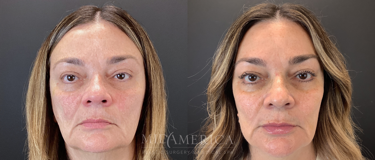Sculptra Before & After