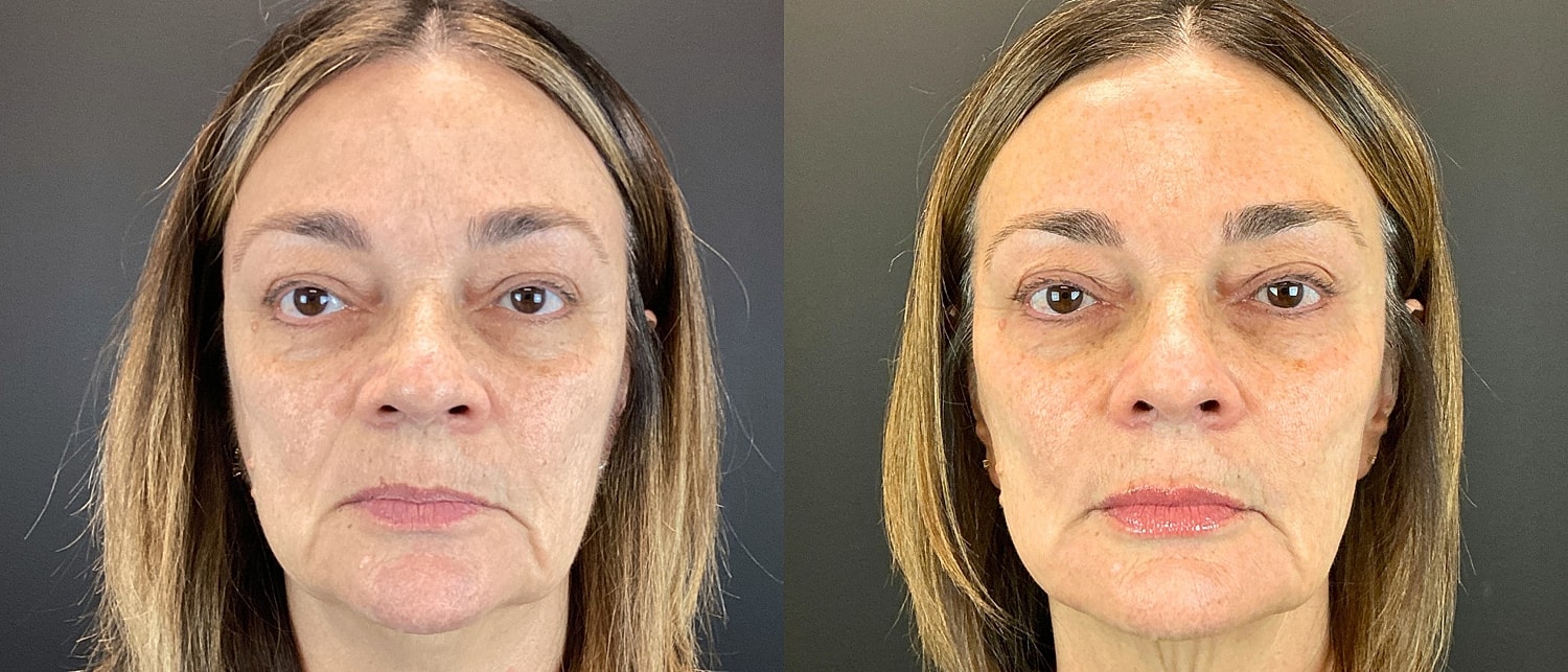 Sculptra Before & After