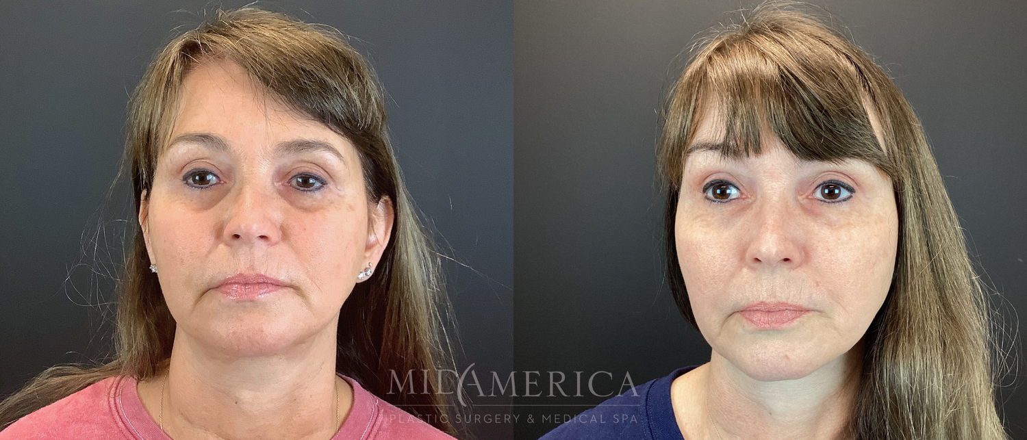 Sculptra Before & After