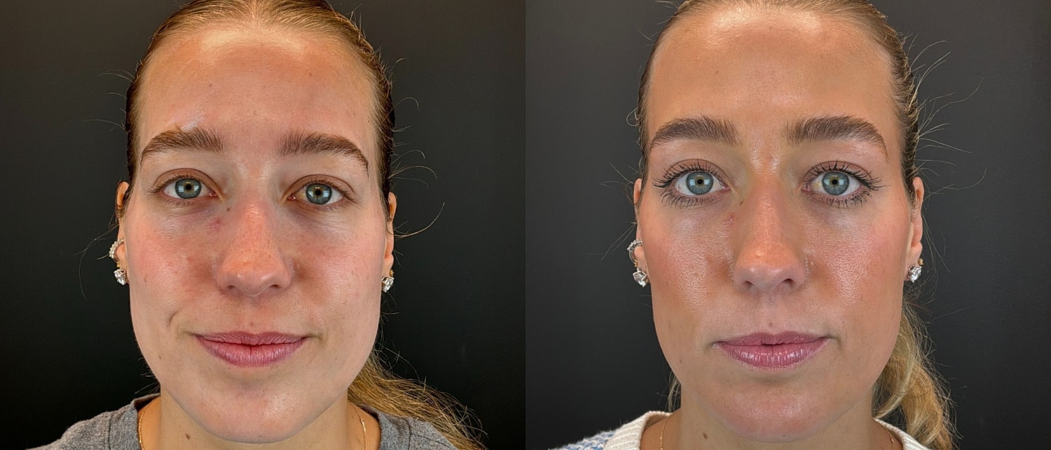 Sculptra Before & After