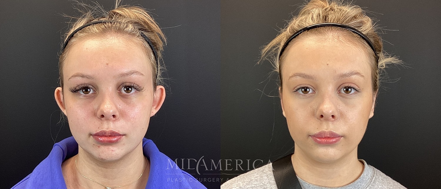 Otoplasty Before & After