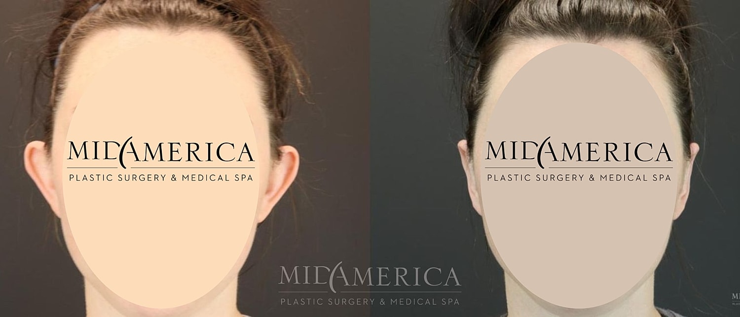 Otoplasty Before & After