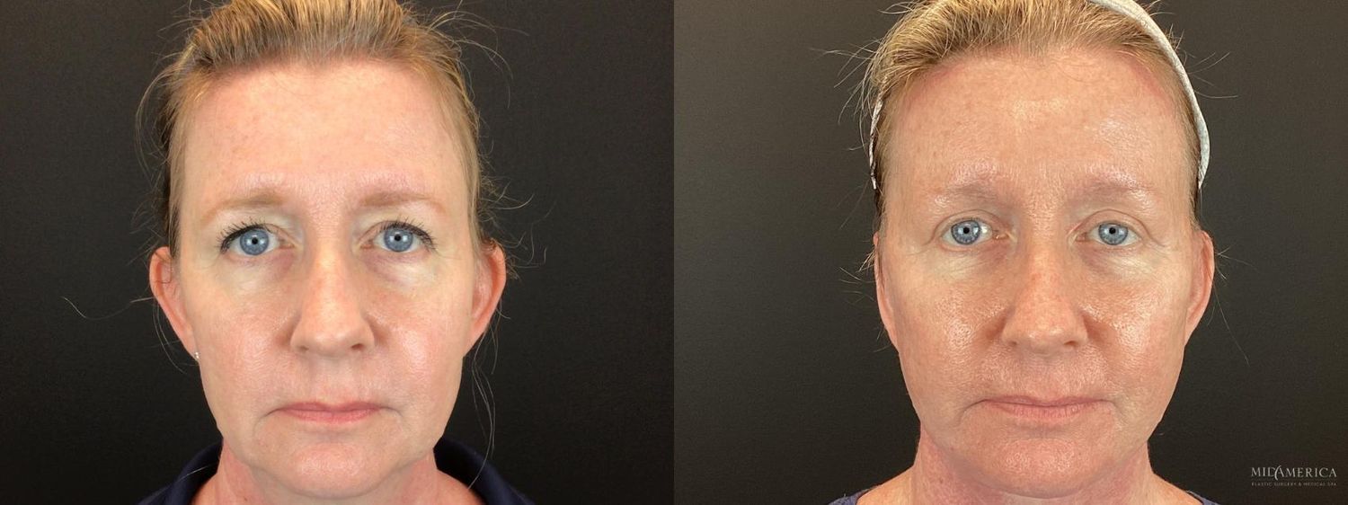 Otoplasty Before & After