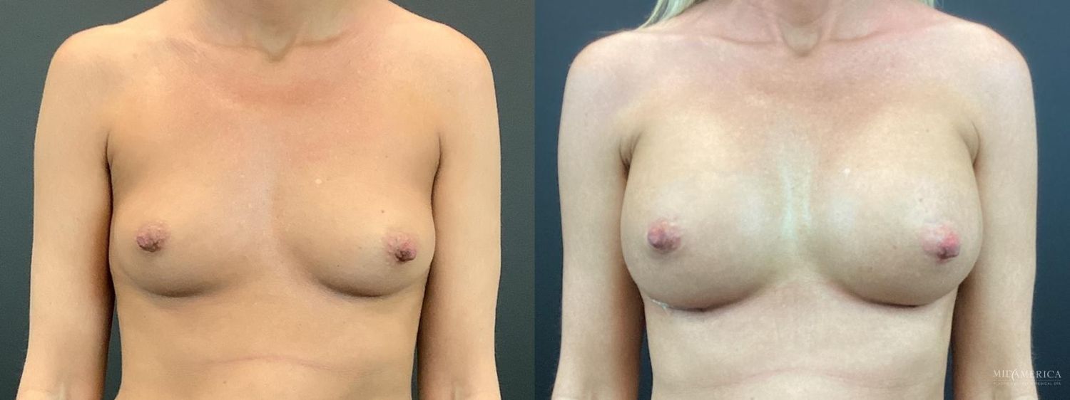 Breast Augmentation Before & After