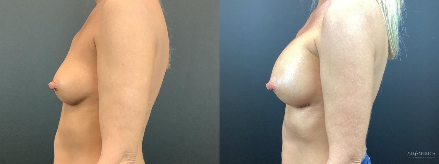 Breast Augmentation Before & After