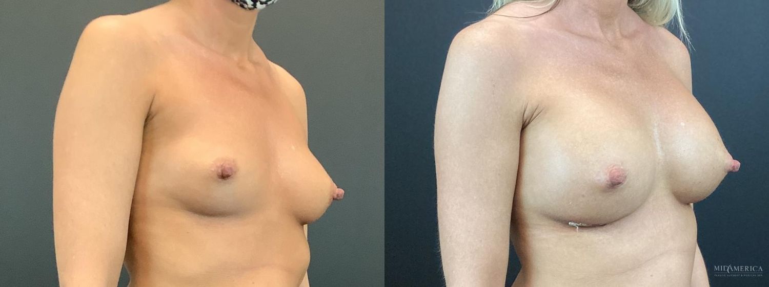 Breast Augmentation Before & After