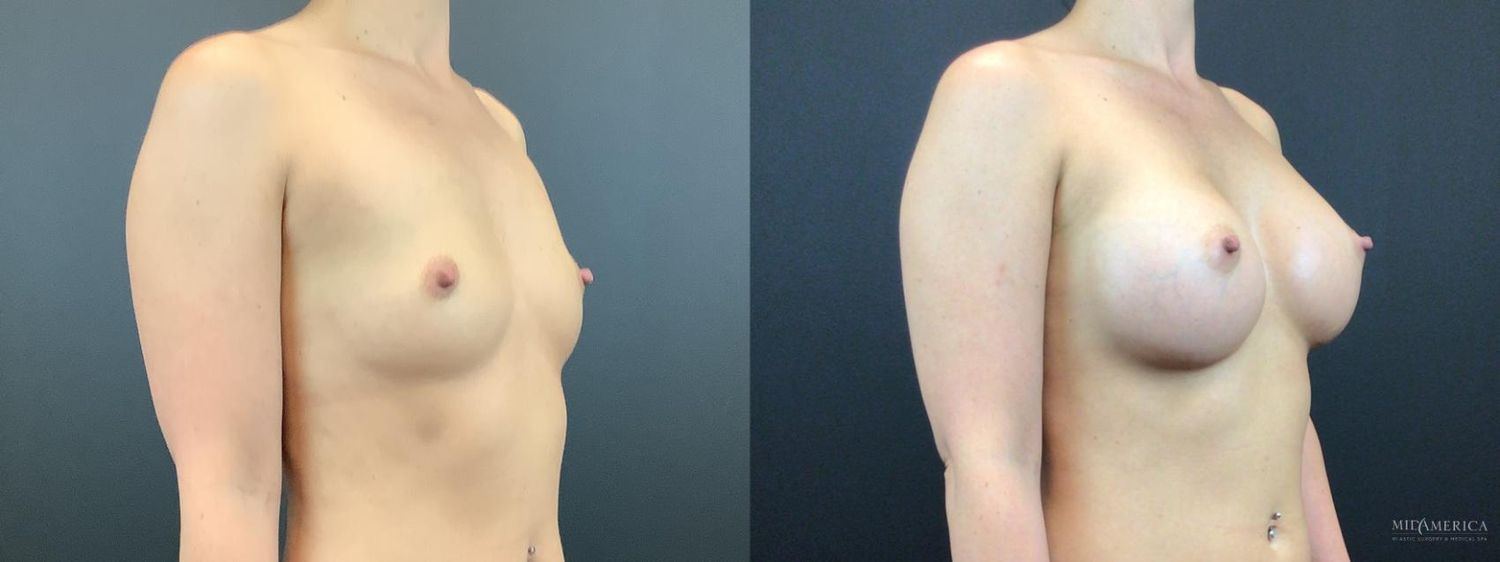 Breast Augmentation Before & After