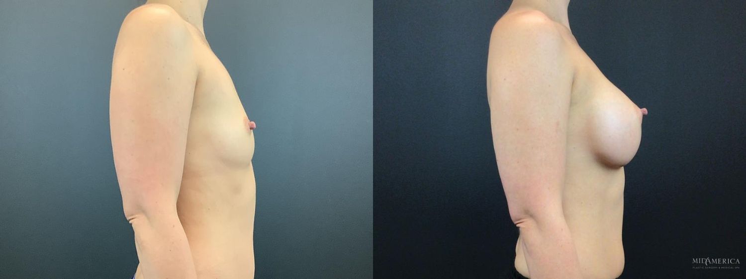 Breast Augmentation Before & After