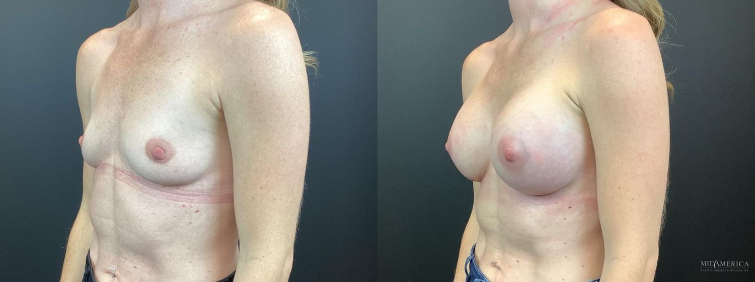 Breast Augmentation Before & After