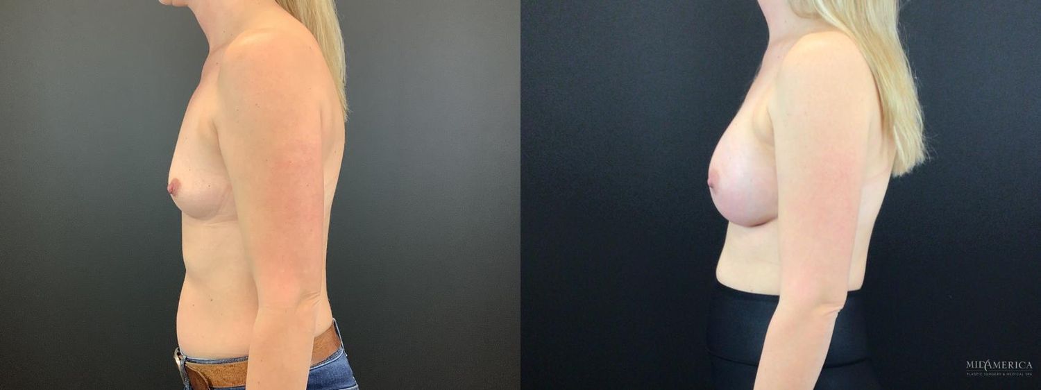 Breast Augmentation Before & After