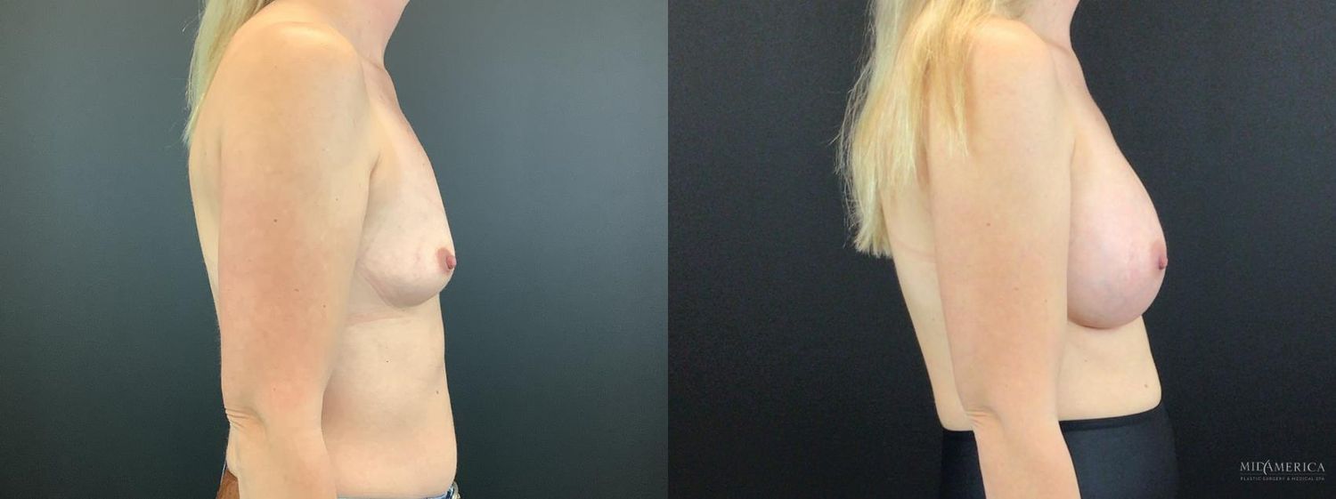 Breast Augmentation Before & After