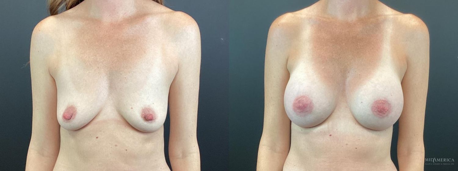 Breast Augmentation Before & After
