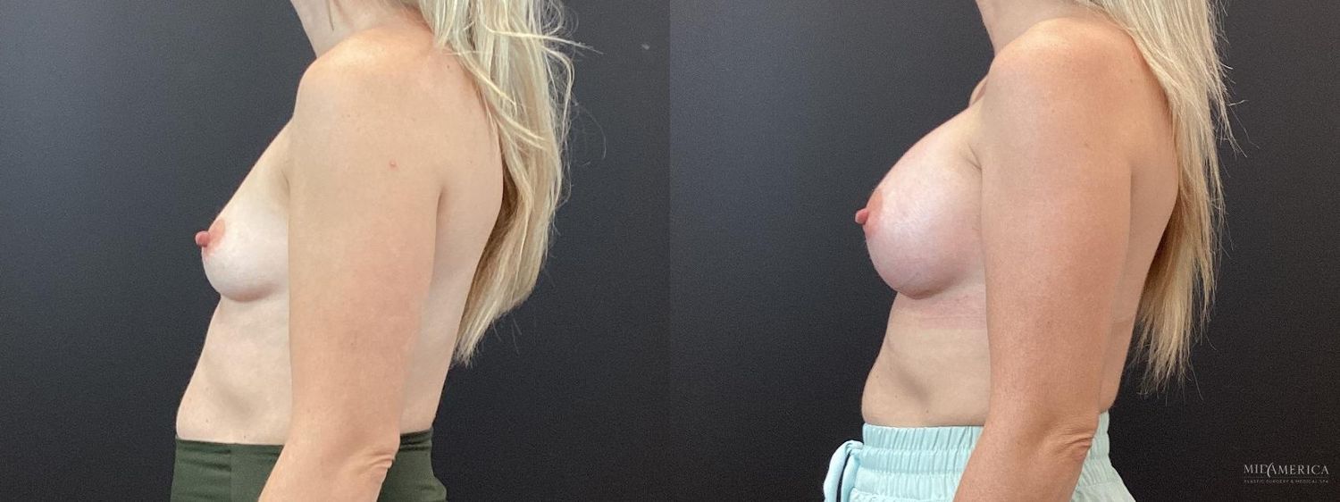 Breast Augmentation Before & After