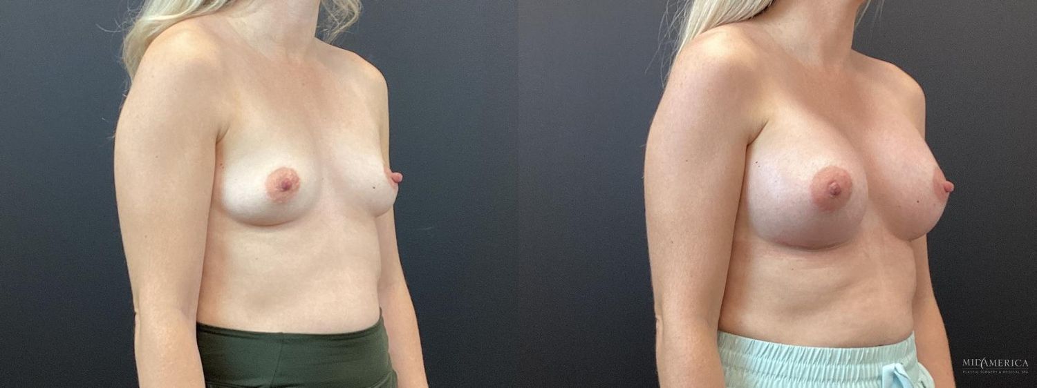 Breast Augmentation Before & After