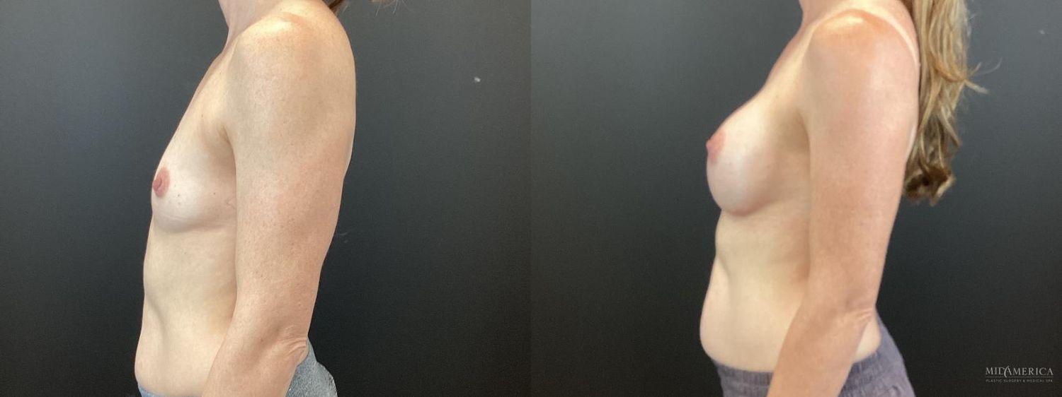 Breast Augmentation Before & After